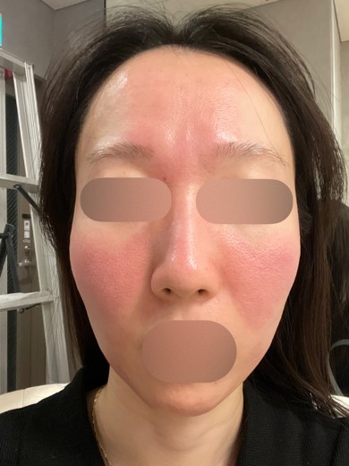 after photo: スキンボトックス, ジュベルック(Juvelook)