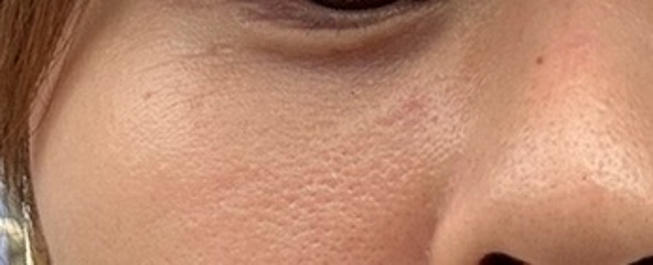 before photo: IPL(光/フォト治療), 診断・検査
