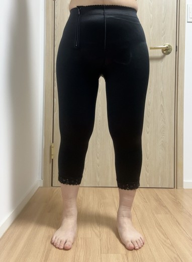 after photo: 허벅지지방흡입