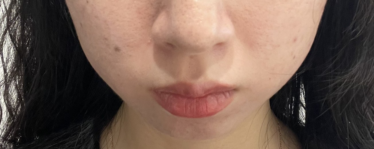 after photo: 사각턱보톡스