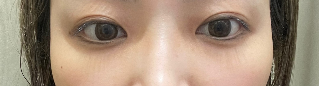 リジュラン注射2本（2cc） 肌再生を高濃度で実感。毛穴・ハリが変わる