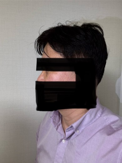 after photo: 눈밑지방재배치