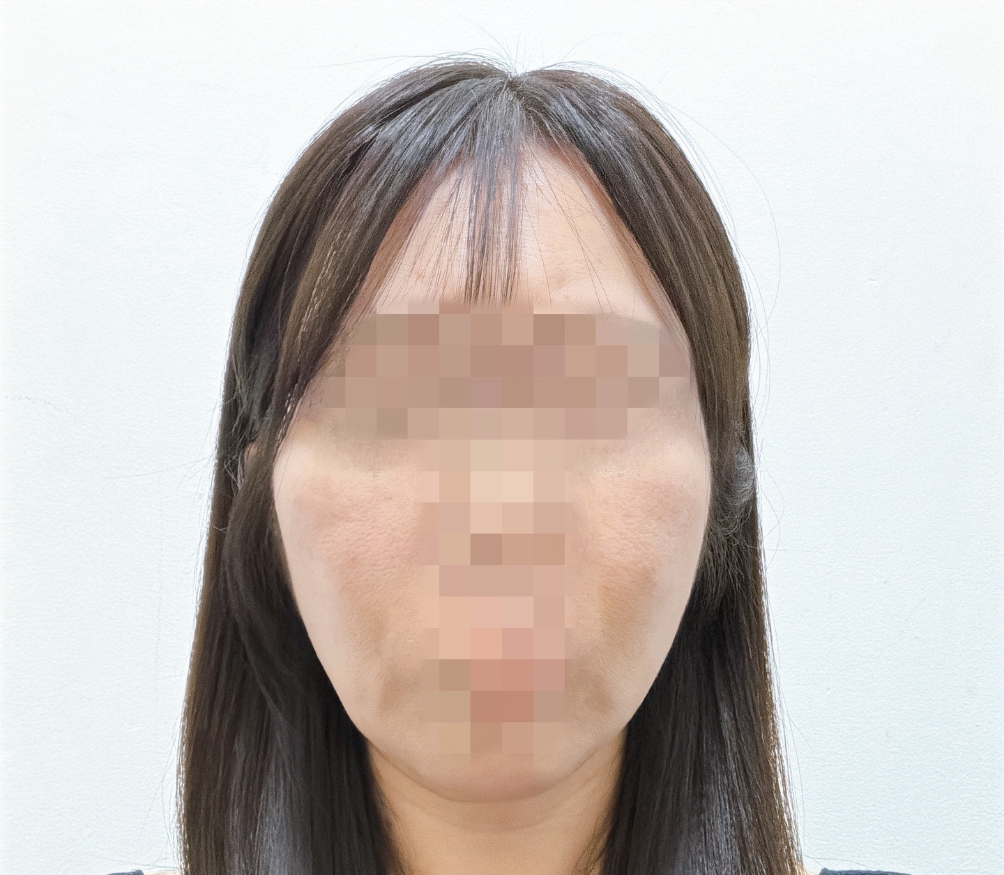 何度でも可】全顔シミ取り放題＋美顔レーザートーニング | ZX-CLINIC