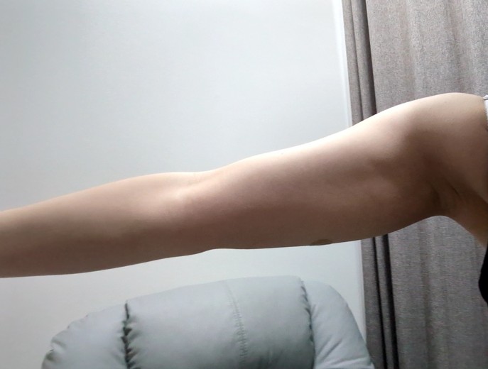 after photo: 脂肪溶解注射(腕), 脂肪溶解注射(太もも)