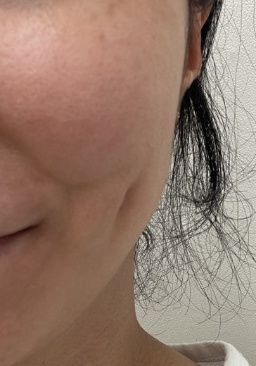 after photo: 보조개성형