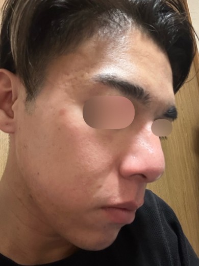 after photo: ダーマペン, エクソソーム
