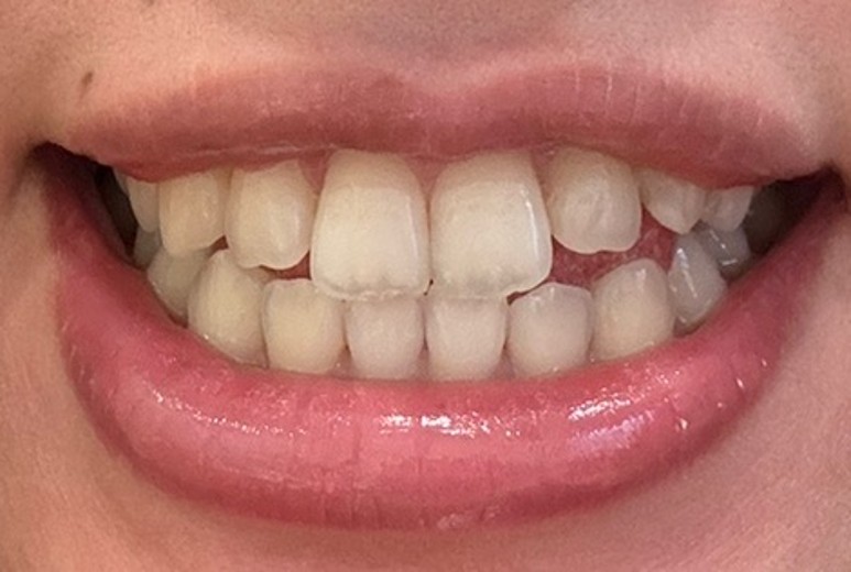 after photo: ホワイトニング