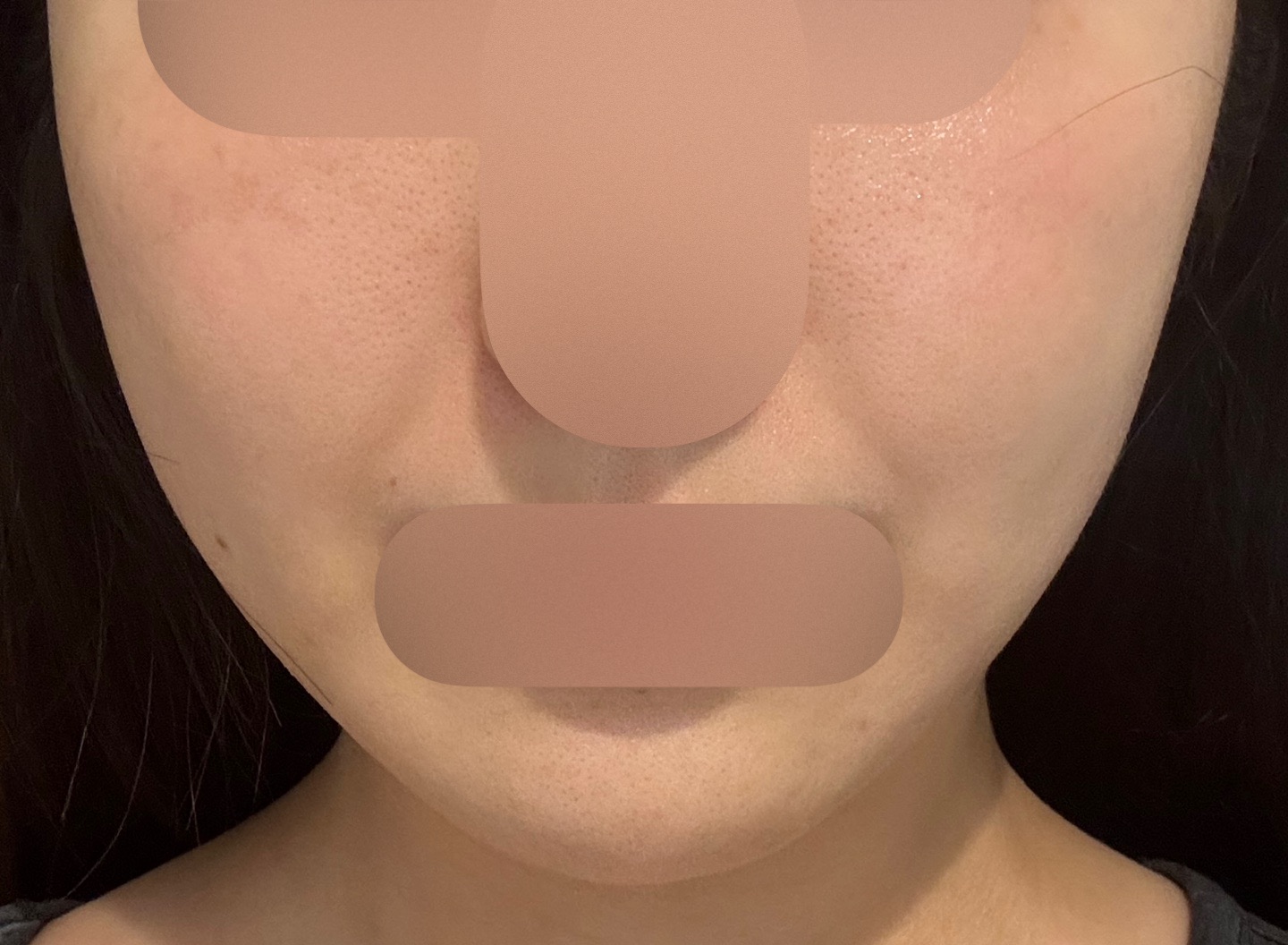 HIFU全顔650shot ウルトラフォーマーMPT【2月28日迄にご予約頂いた方