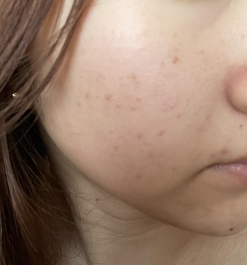 after photo: IPL(光/フォト治療), 診断・検査