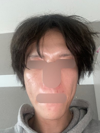 after photo: ダーマペン