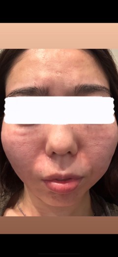 after photo: リジュランスキンブースター
