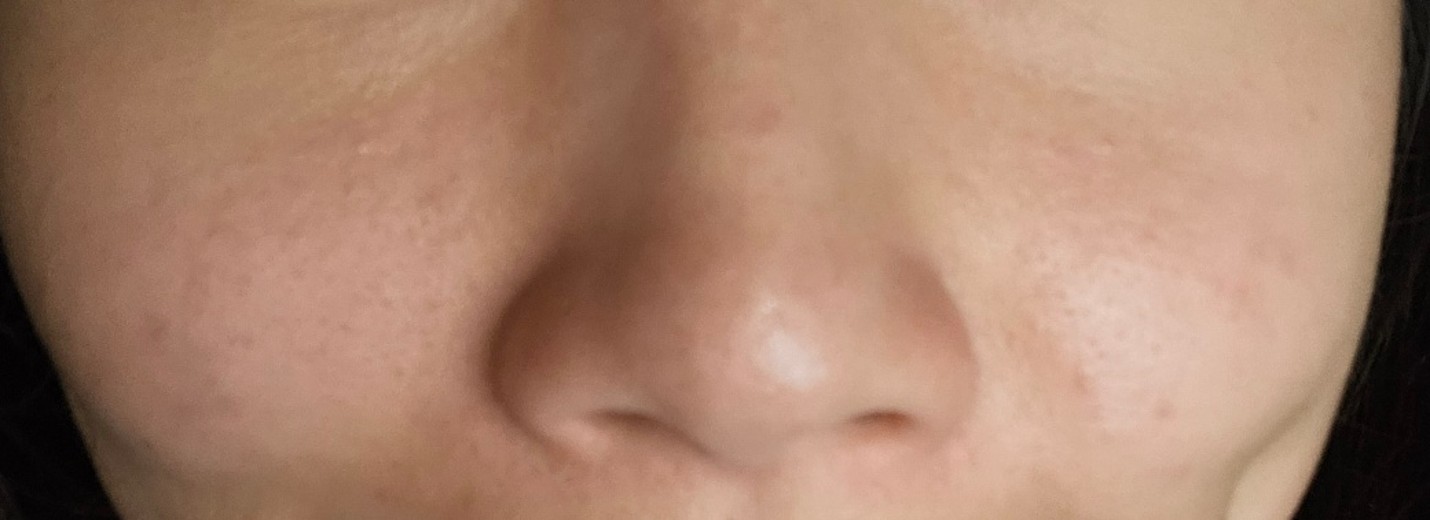 before photo: 콧볼축소