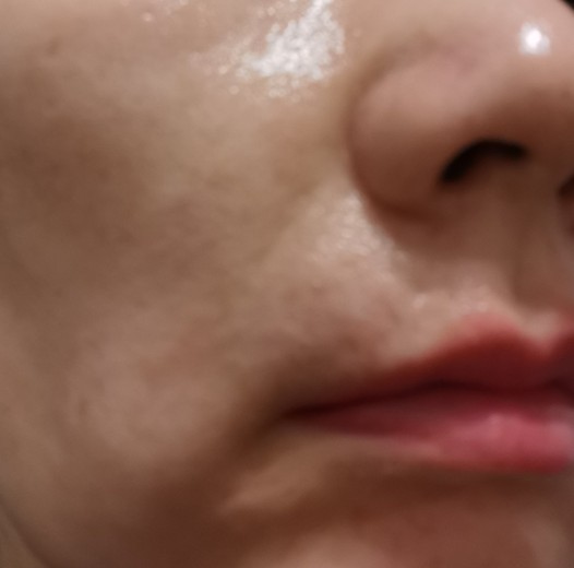 after photo: 脂肪溶解注射(顔)