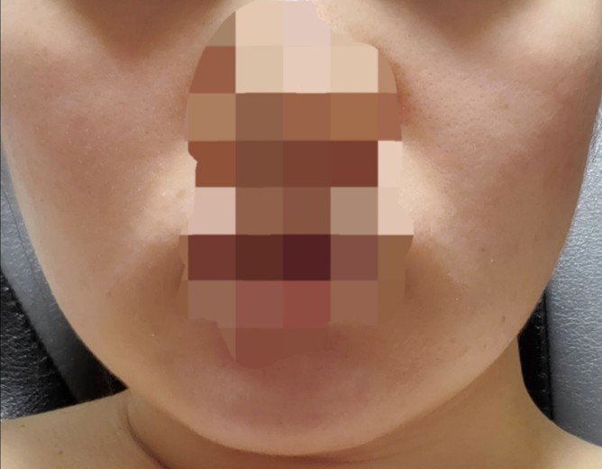 after photo: 脂肪溶解注射(顔)