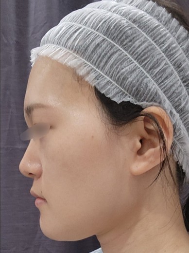 after photo: チタニウムリフト