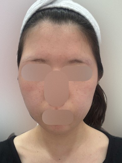 before photo: 슈링크유니버스