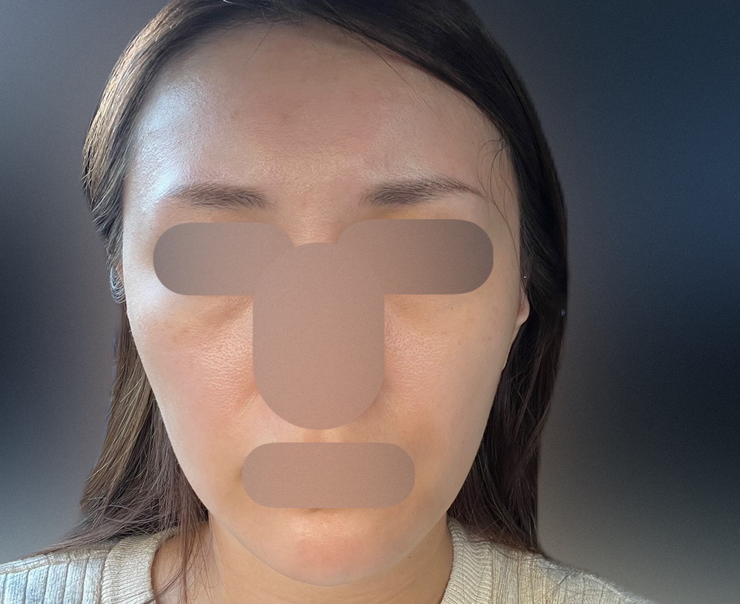 ピーリング　エレクトロポレーション エレクトロポレーション＋ピーリング | フォンタナクリニック天神