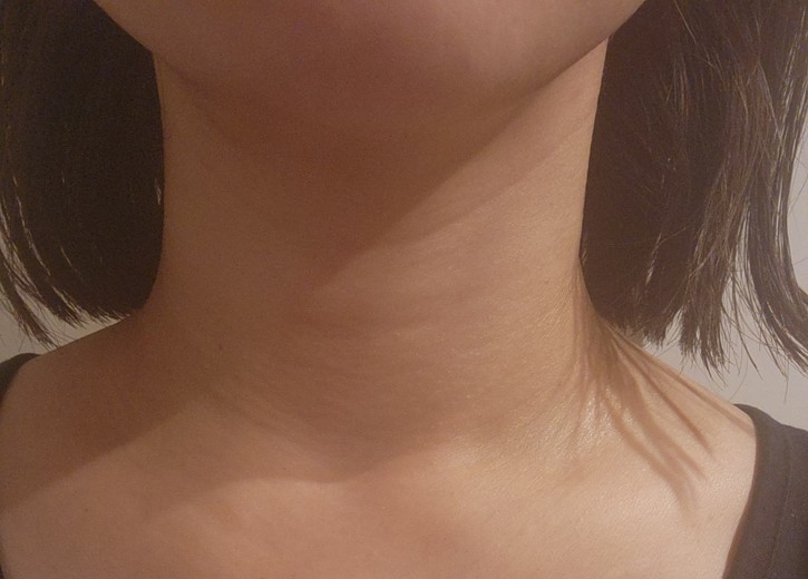 after photo: イオン導入