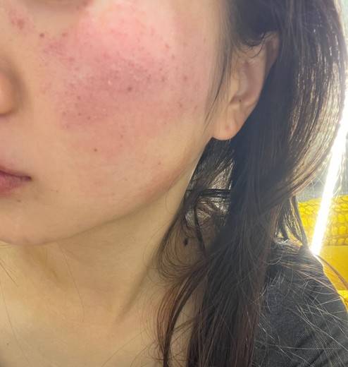 after photo: PDTレーザー, フラクショナルレーザー, レーザートーニング, ほくろ除去(レーザー)