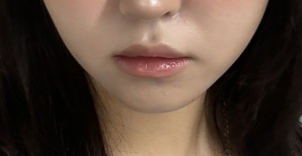 before photo: 윤곽주사, 얼굴지방분해주사