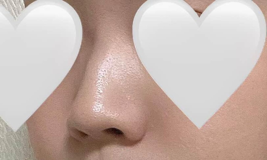 before photo: 콧대(보형물), 코끝(자가연골), 복코교정(수술)