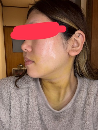 after photo: 糸リフト, 脂肪吸引(顎下), 脂肪吸引(顔), 脂肪吸引(頬)