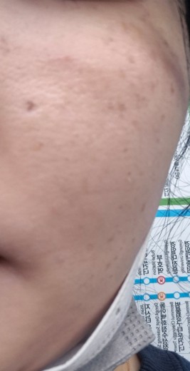 after photo: 레이저토닝