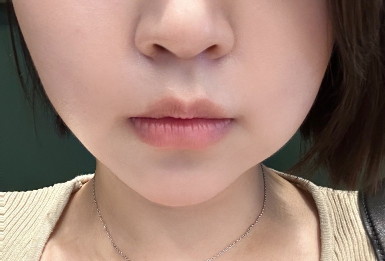 before photo: 입꼬리필러, 입술필러