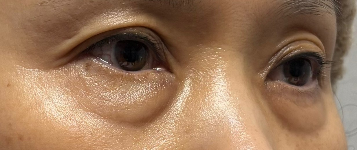 before photo: 눈밑지방재배치