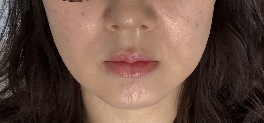 after photo: 스킨보톡스