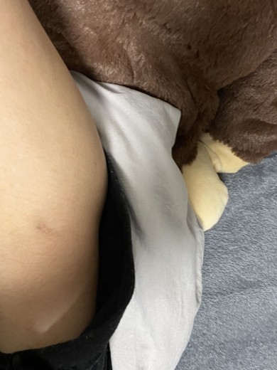 after photo: 脂肪吸引(腕)