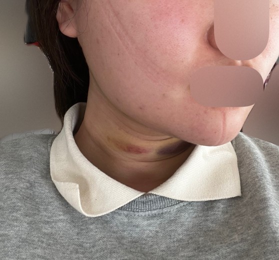after photo: 脂肪吸引注射