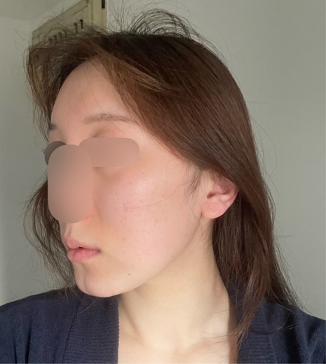 after photo: ピーリング, エレクトロポレーション