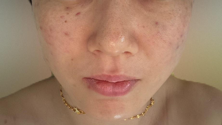 after photo: 스킨보톡스