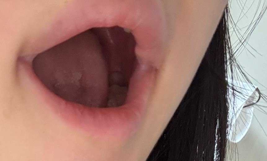 after photo: 실리프팅