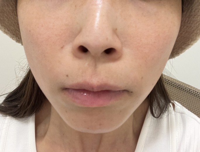 before photo: ピコトーニング, ピコフラクショナル