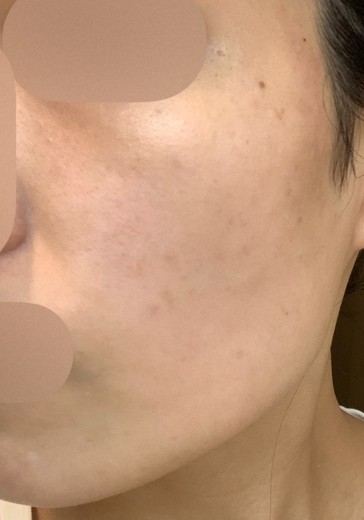 after photo: IPL(光/フォト治療), ルメッカ