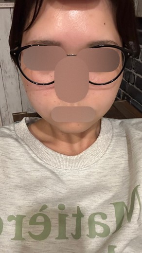 after photo: インモード