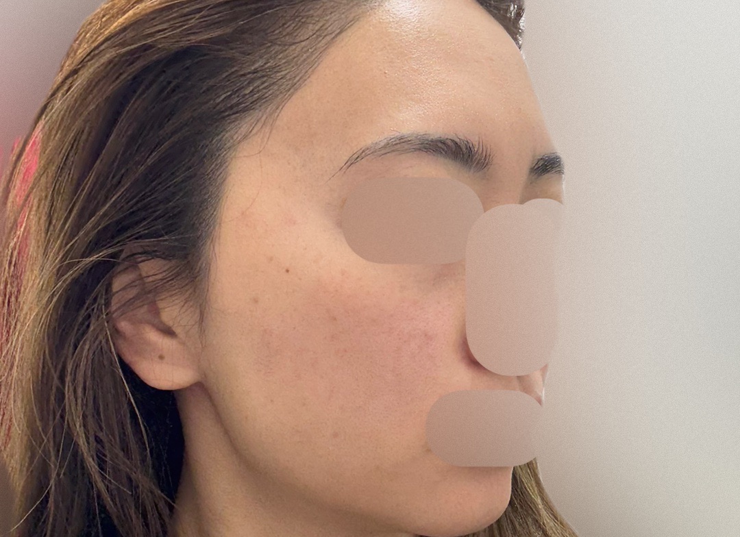 ピコトーニング＋イオン導入（ビタミンC or トラネキサム酸） | MK