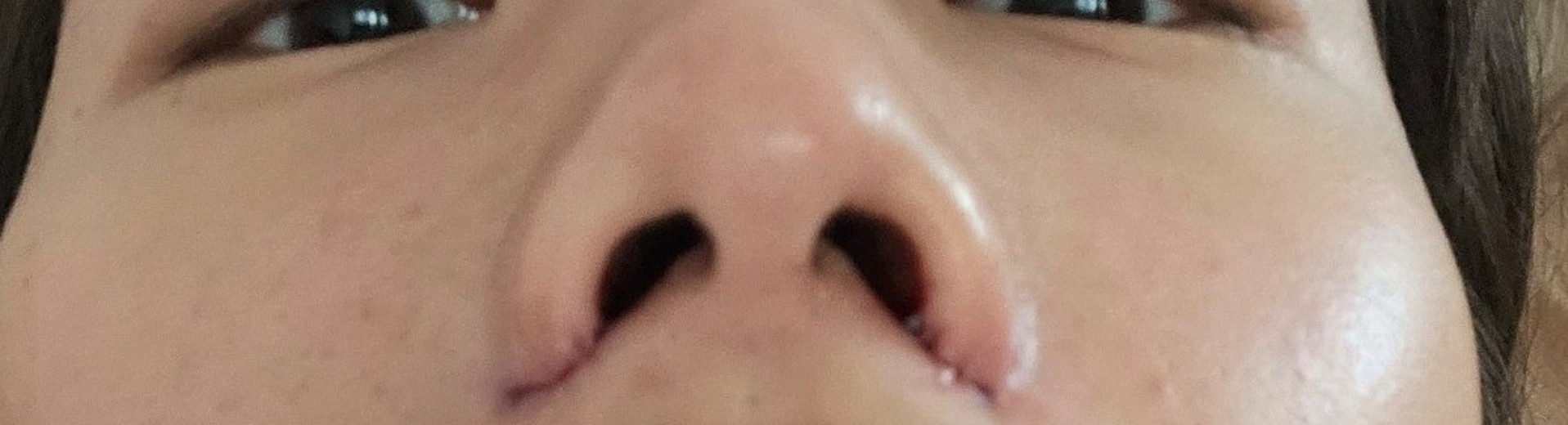 after photo: 콧볼축소