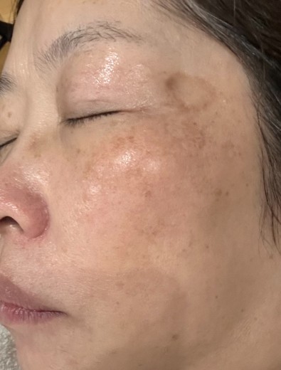 after photo: IPL(光/フォト治療)