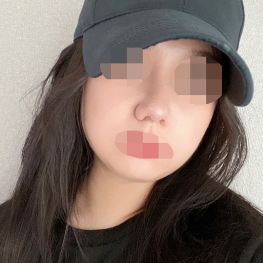 after photo: 콧볼축소