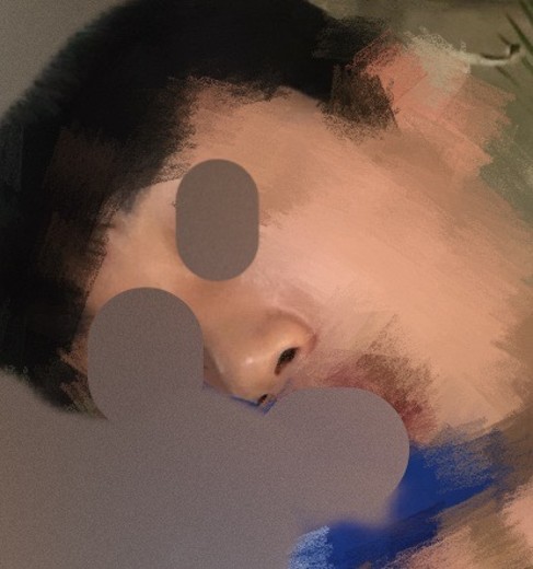 before photo: 콧대(보형물), 코끝(자가연골)