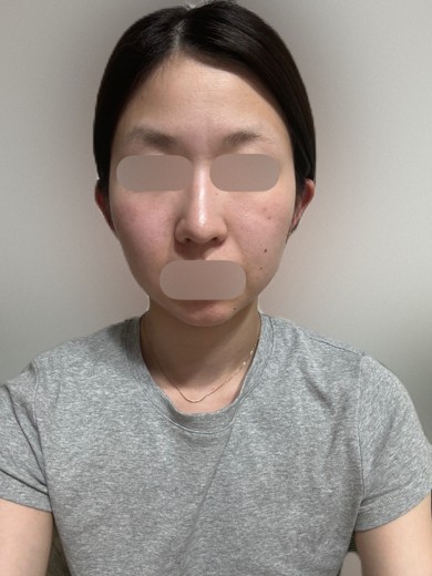 after photo: エラボトックス