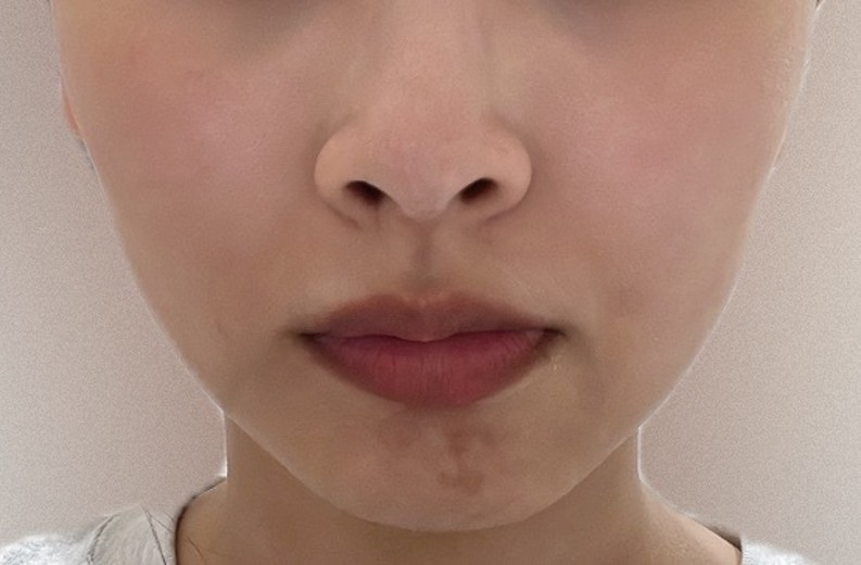 before photo: IPL(光/フォト治療), ルメッカ