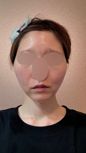 after photo: フラクショナルレーザー, エレクトロポレーション, Qスイッチレーザー