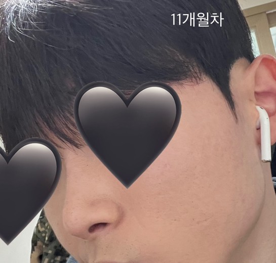 after photo: 코끝(자가연골), 복코교정(수술)