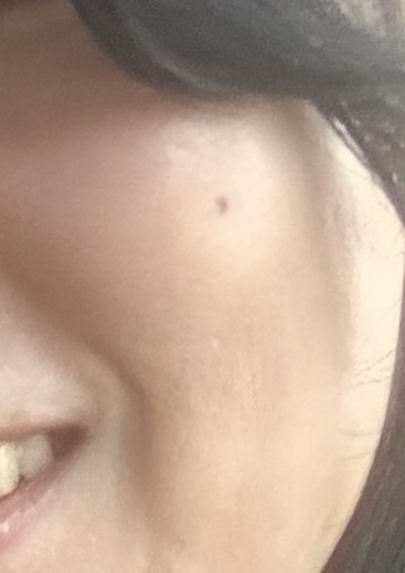 before photo: 스킨보톡스