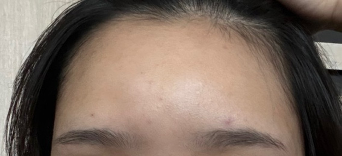 after photo: 이마필러, 관자놀이필러