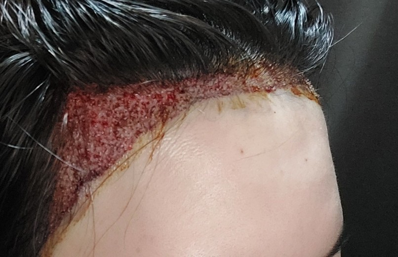 after photo: 머리모발이식